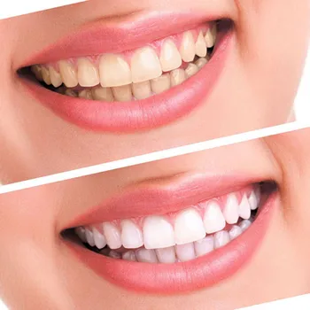3/6/10pcs LED Luči Komplet za Beljenje Zob Zob Gel Whitener Odstrani Plaketo Belilno Zobno Orodje Za Osebno Zobozdravstvena Oprema