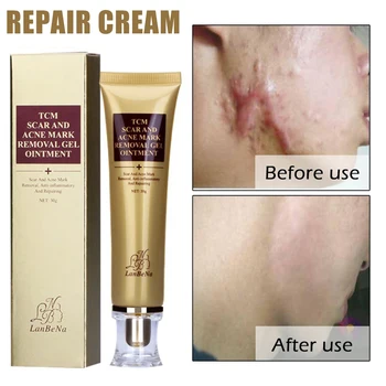 Scar Removal Cream Akne Odstranitev Zdravljenje Stretch Mark Brazgotina Mazilo 30 g KG66