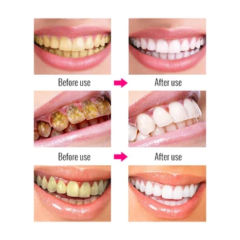OMYLADY 3PCS Zob Ustno Higieno Bistvo Zob Bistvu Vsakodnevno Uporabo Učinkovito Odstranjevanje zobnih Oblog Čiščenje Madežev Izdelek Čiščenje zob